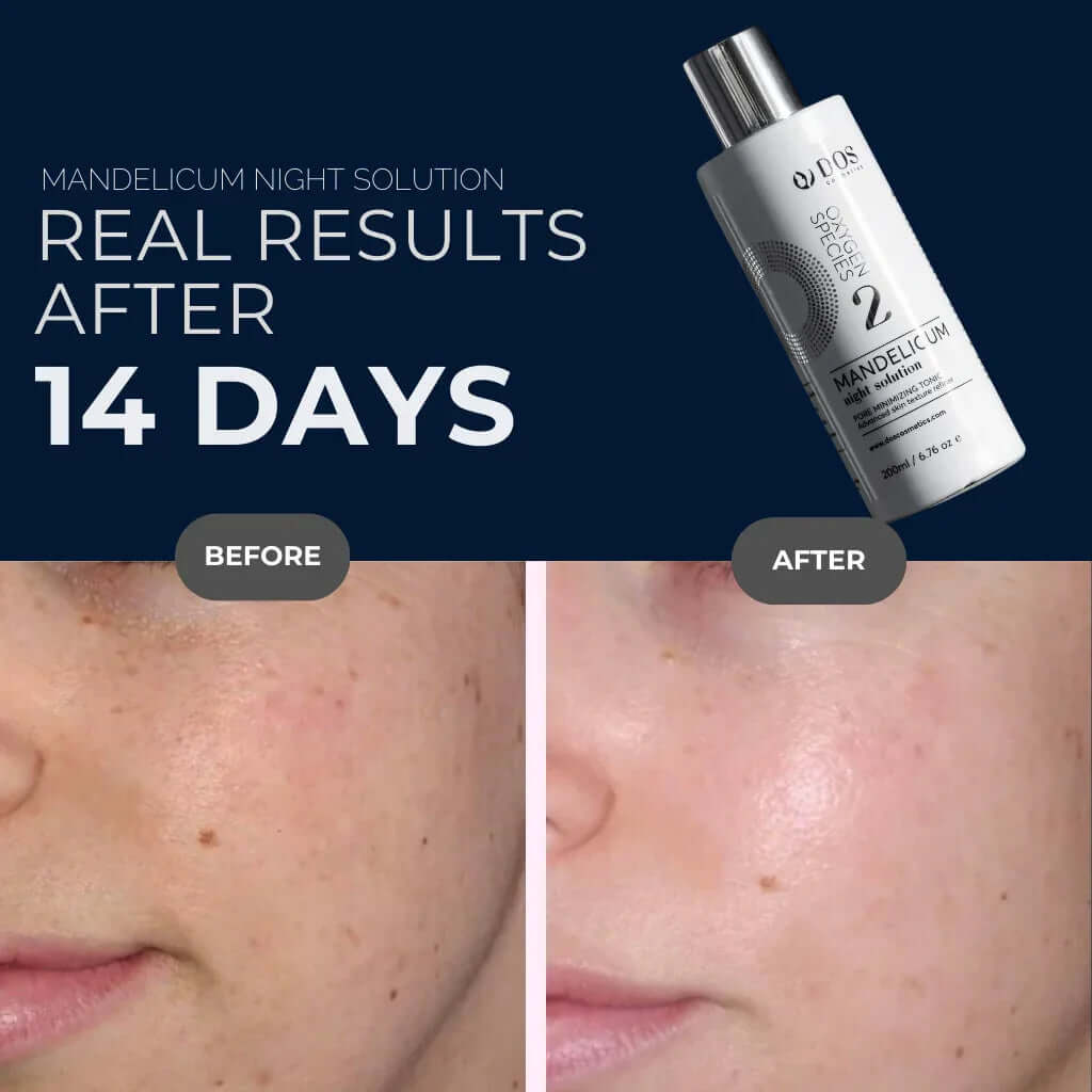 Mandelic Acid Solution before and after results after using Mandelicum Night Award-Winning Solution for 14 days. DOS Cosmetics
