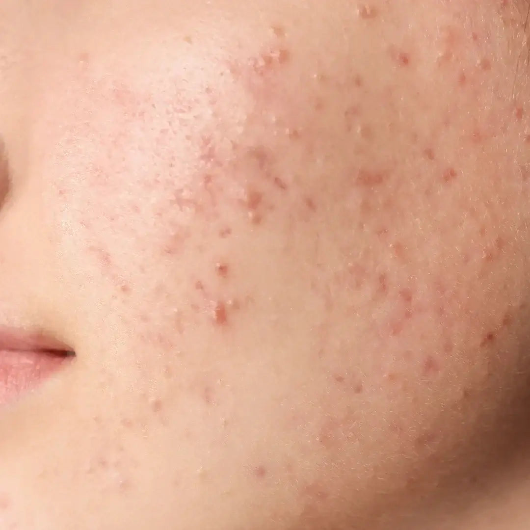 ACNE SKINCARE - DOS Cosmetics