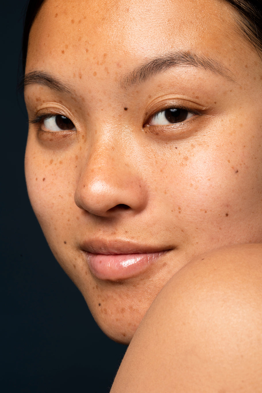HYPERPIGMENTATION