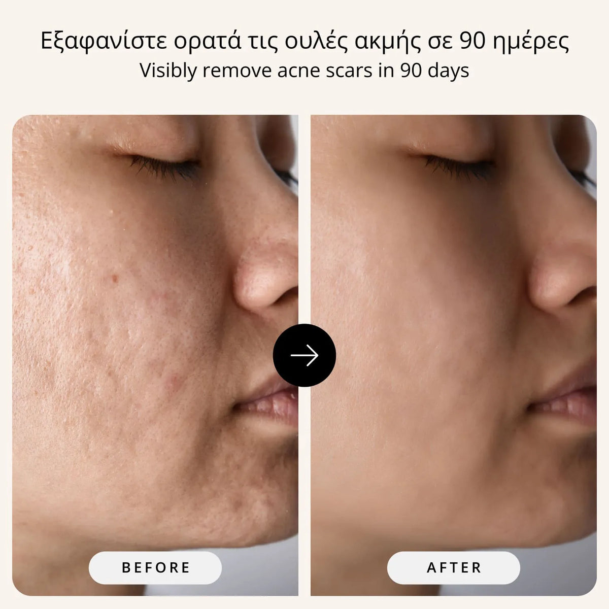 The Complete Acne Scars Removal Protocol