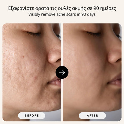 The Complete Acne Scars Removal Protocol